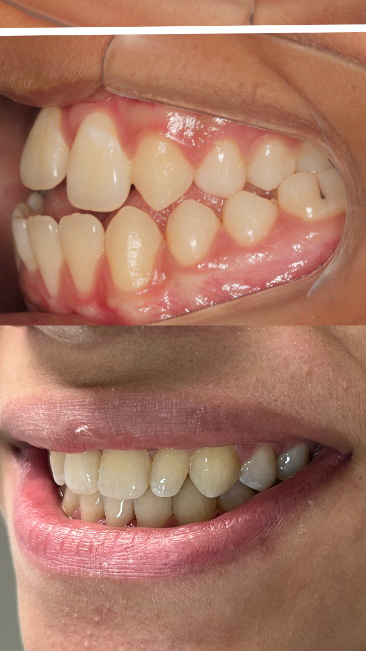 Antes e depois de tratamento ortodôntico realizado pela OdontoMAP